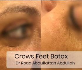 crows-feet-botox