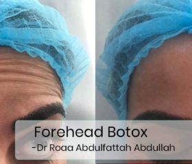 forehead-botox-1