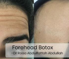 forehead-botox