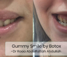 gummy-smile-by-botox