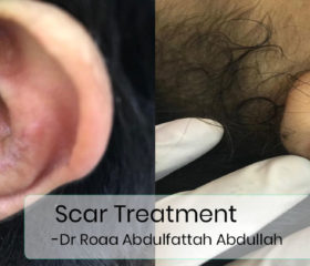 scar-treatment